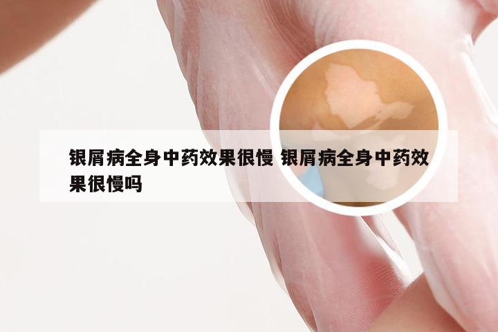银屑病全身中药效果很慢 银屑病全身中药效果很慢吗