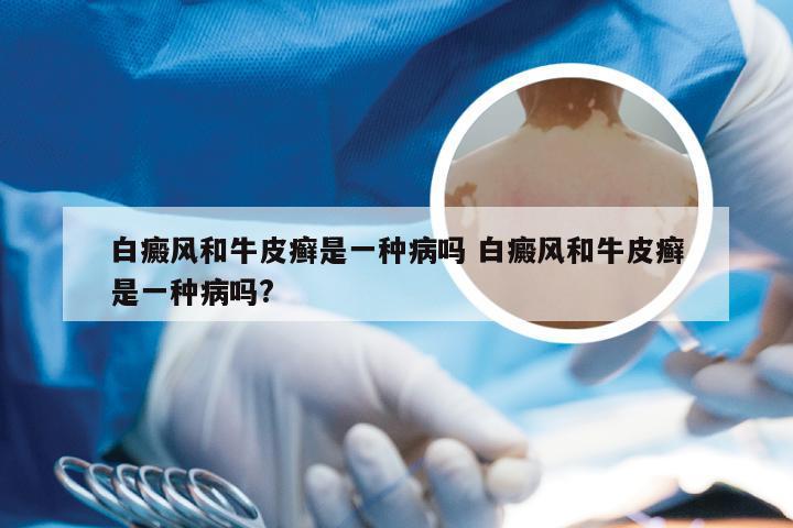白癜风和牛皮癣是一种病吗 白癜风和牛皮癣是一种病吗?