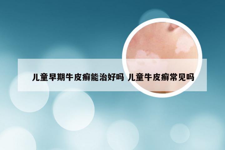 儿童早期牛皮癣能治好吗 儿童牛皮癣常见吗