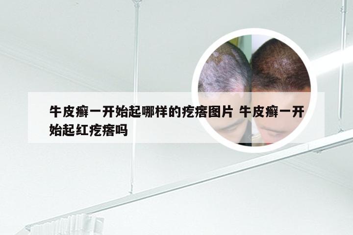 牛皮癣一开始起哪样的疙瘩图片 牛皮癣一开始起红疙瘩吗