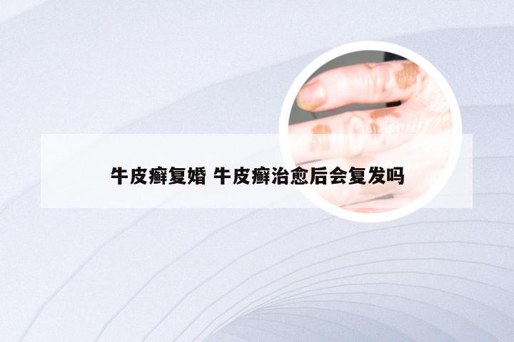 牛皮癣复婚 牛皮癣治愈后会复发吗