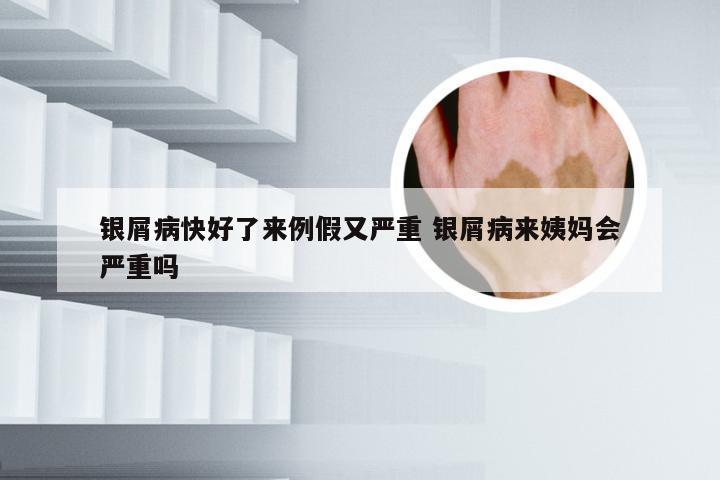 银屑病快好了来例假又严重 银屑病来姨妈会严重吗