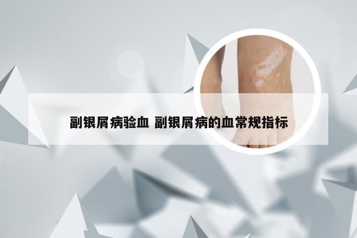 副银屑病验血 副银屑病的血常规指标