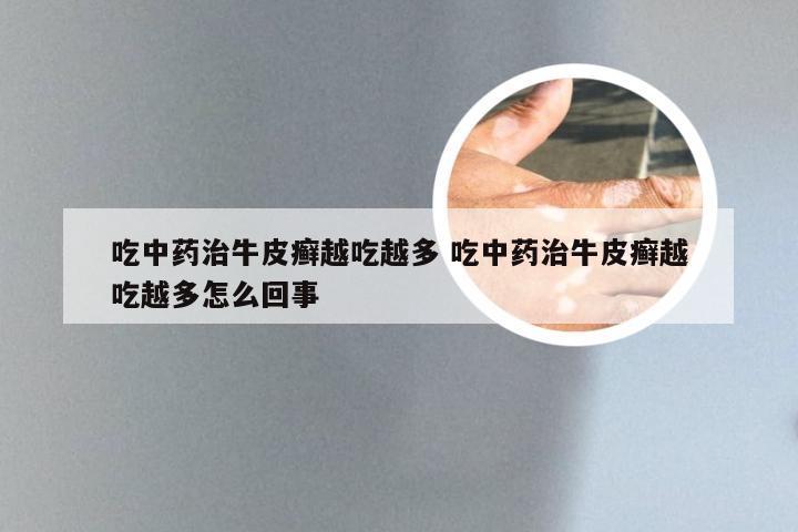 吃中药治牛皮癣越吃越多 吃中药治牛皮癣越吃越多怎么回事