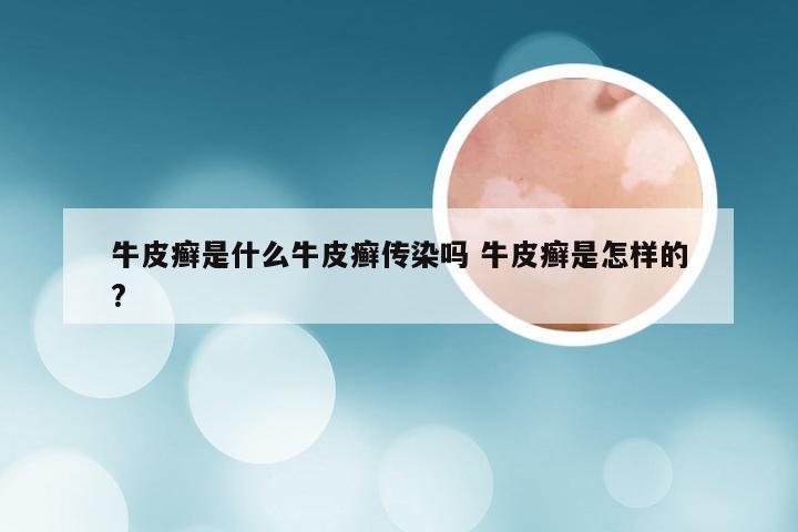 牛皮癣是什么牛皮癣传染吗 牛皮癣是怎样的?