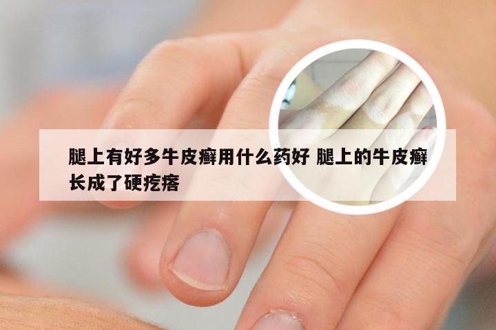 腿上有好多牛皮癣用什么药好 腿上的牛皮癣长成了硬疙瘩