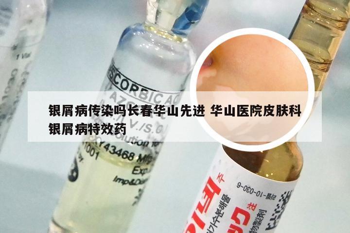 银屑病传染吗长春华山先进 华山医院皮肤科银屑病特效药