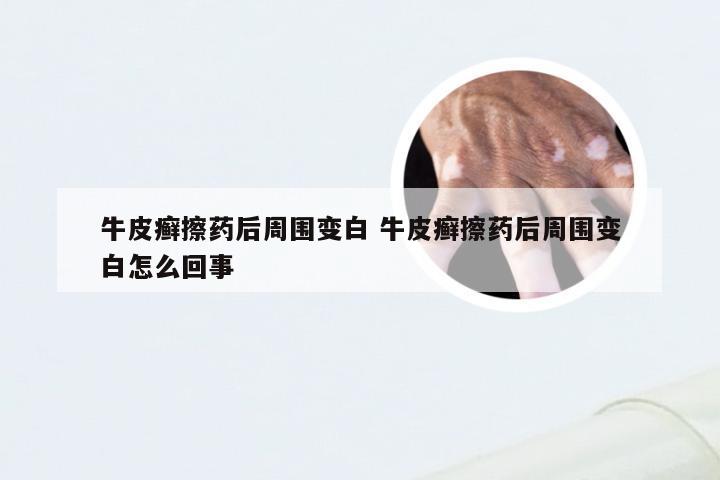牛皮癣擦药后周围变白 牛皮癣擦药后周围变白怎么回事
