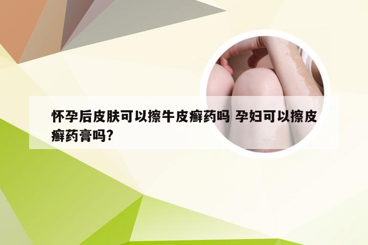 怀孕后皮肤可以擦牛皮癣药吗 孕妇可以擦皮癣药膏吗?