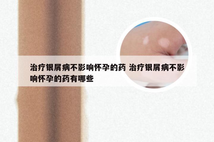 治疗银屑病不影响怀孕的药 治疗银屑病不影响怀孕的药有哪些