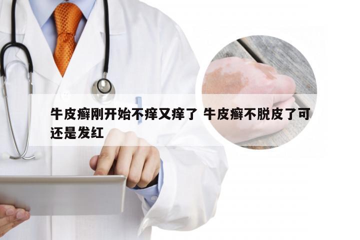 牛皮癣刚开始不痒又痒了 牛皮癣不脱皮了可还是发红