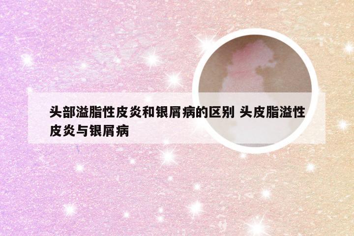头部溢脂性皮炎和银屑病的区别 头皮脂溢性皮炎与银屑病