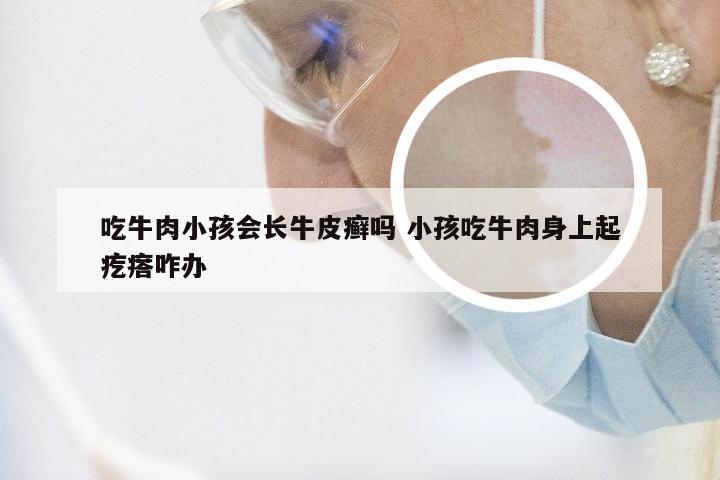 吃牛肉小孩会长牛皮癣吗 小孩吃牛肉身上起疙瘩咋办