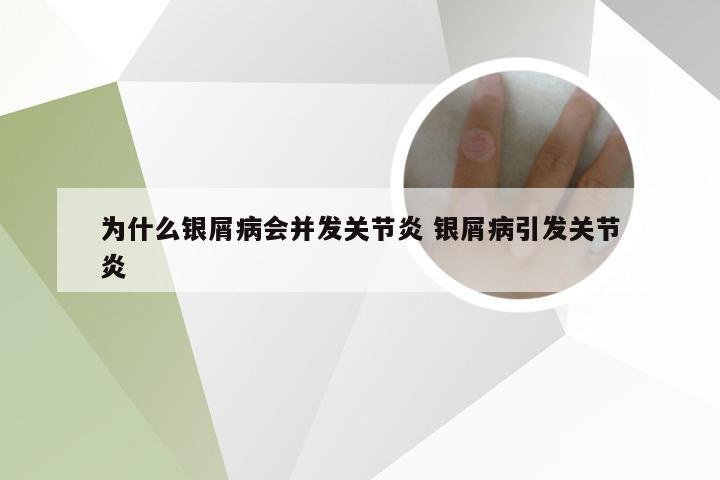 为什么银屑病会并发关节炎 银屑病引发关节炎