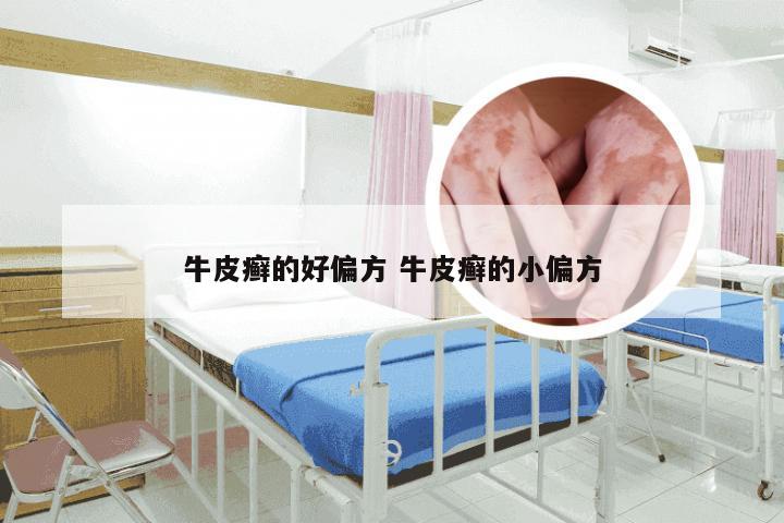 牛皮癣的好偏方 牛皮癣的小偏方