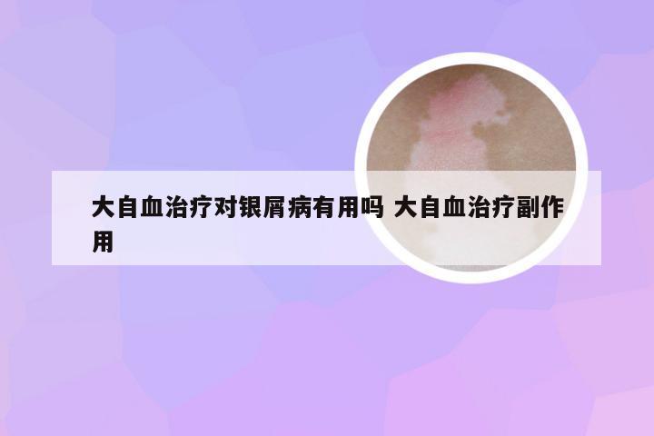 大自血治疗对银屑病有用吗 大自血治疗副作用