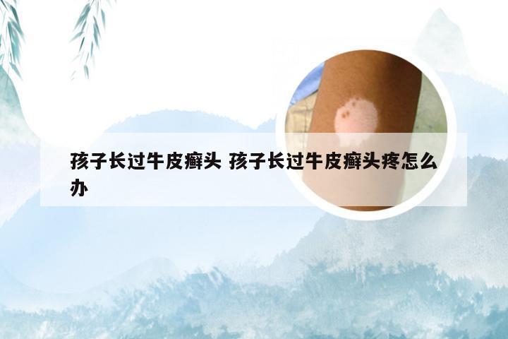 孩子长过牛皮癣头 孩子长过牛皮癣头疼怎么办