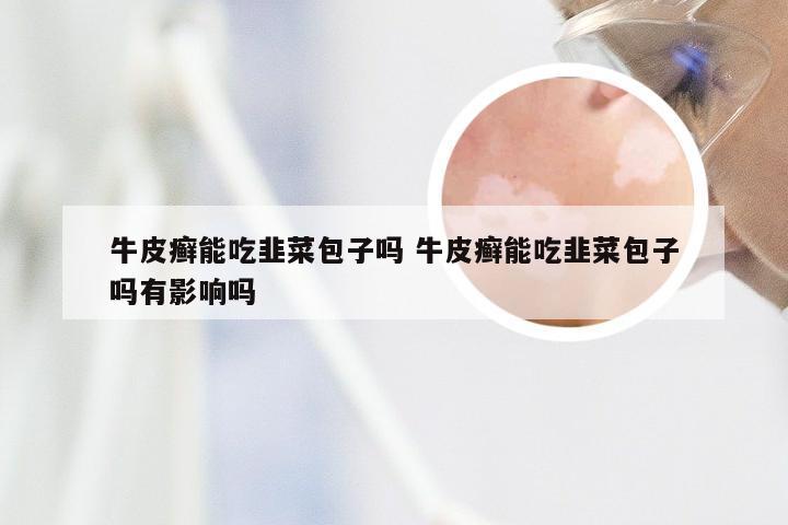 牛皮癣能吃韭菜包子吗 牛皮癣能吃韭菜包子吗有影响吗