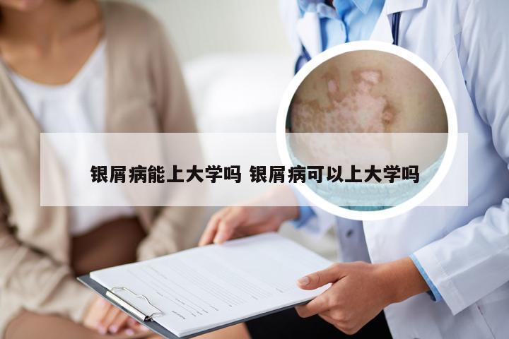 银屑病能上大学吗 银屑病可以上大学吗