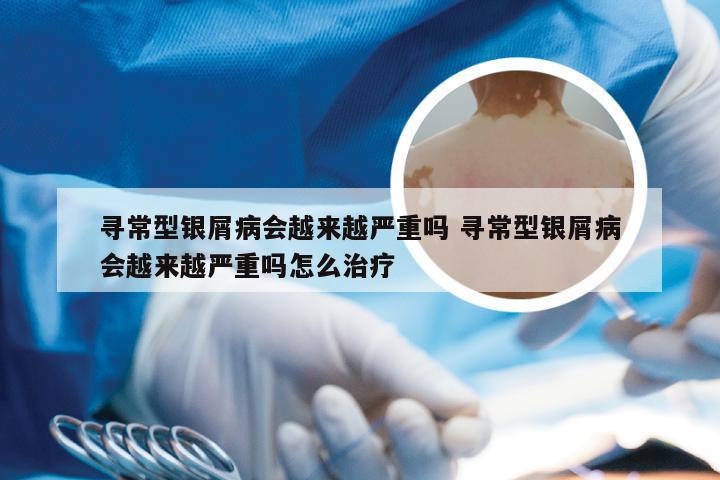 寻常型银屑病会越来越严重吗 寻常型银屑病会越来越严重吗怎么治疗