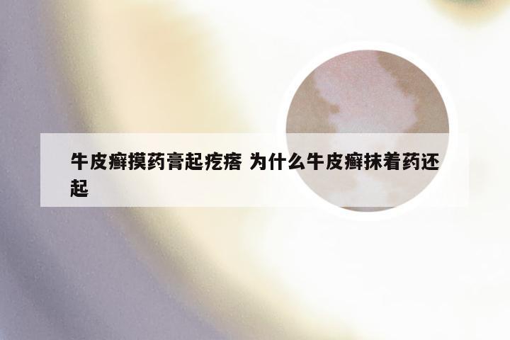 牛皮癣摸药膏起疙瘩 为什么牛皮癣抹着药还起