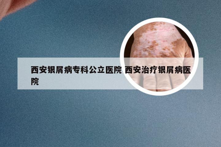 西安银屑病专科公立医院 西安治疗银屑病医院
