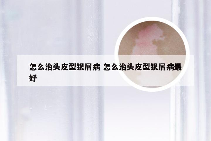 怎么治头皮型银屑病 怎么治头皮型银屑病最好