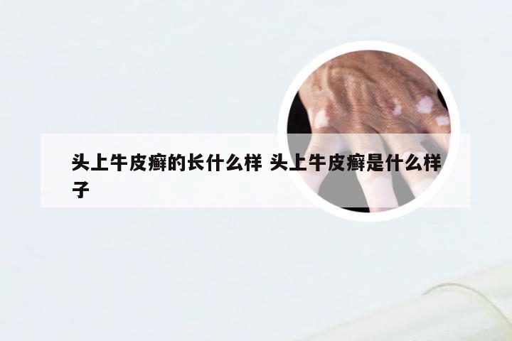 头上牛皮癣的长什么样 头上牛皮癣是什么样子