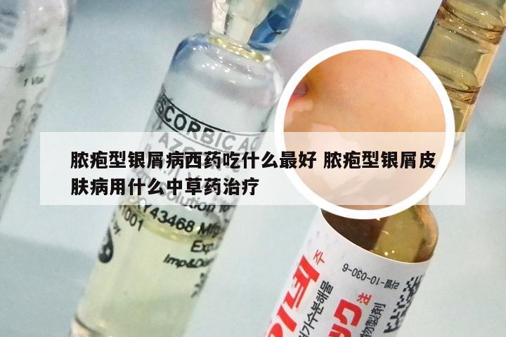脓疱型银屑病西药吃什么最好 脓疱型银屑皮肤病用什么中草药治疗