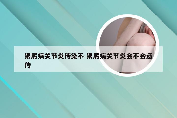 银屑病关节炎传染不 银屑病关节炎会不会遗传