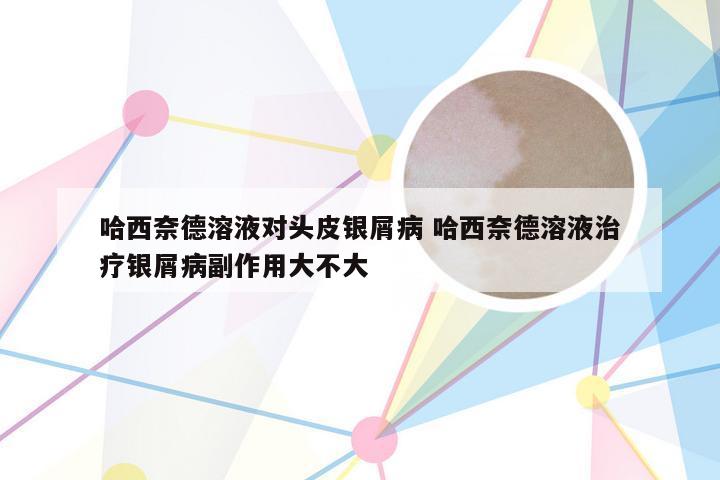 哈西奈德溶液对头皮银屑病 哈西奈德溶液治疗银屑病副作用大不大