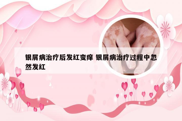 银屑病治疗后发红变痒 银屑病治疗过程中忽然发红