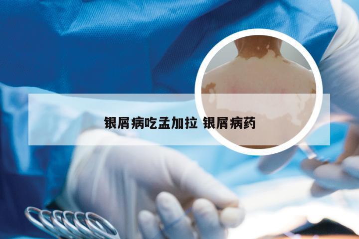 银屑病吃孟加拉 银屑病药