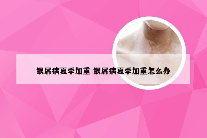 银屑病夏季加重 银屑病夏季加重怎么办