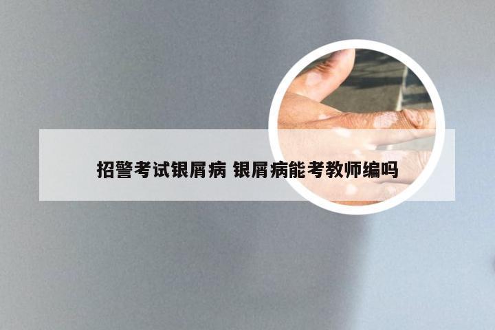 招警考试银屑病 银屑病能考教师编吗