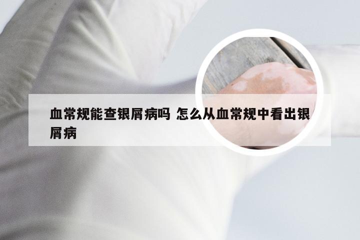 血常规能查银屑病吗 怎么从血常规中看出银屑病
