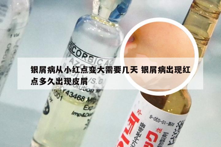 银屑病从小红点变大需要几天 银屑病出现红点多久出现皮屑