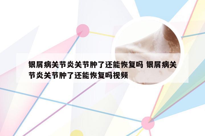 银屑病关节炎关节肿了还能恢复吗 银屑病关节炎关节肿了还能恢复吗视频