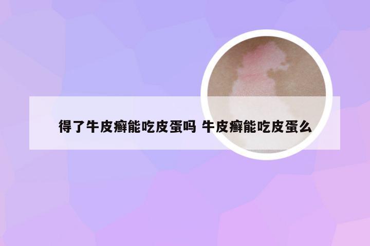 得了牛皮癣能吃皮蛋吗 牛皮癣能吃皮蛋么