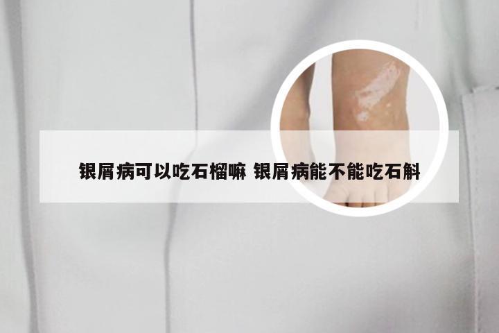 银屑病可以吃石榴嘛 银屑病能不能吃石斛