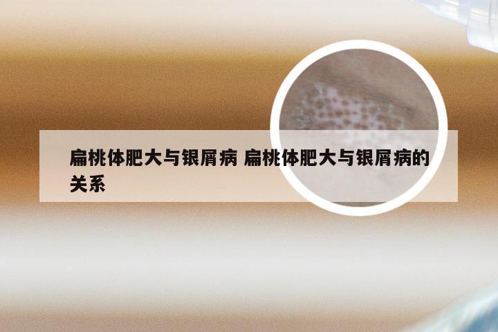 扁桃体肥大与银屑病 扁桃体肥大与银屑病的关系