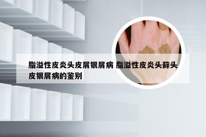 脂溢性皮炎头皮屑银屑病 脂溢性皮炎头藓头皮银屑病的鉴别