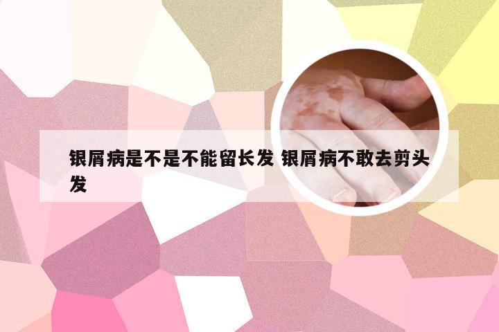 银屑病是不是不能留长发 银屑病不敢去剪头发