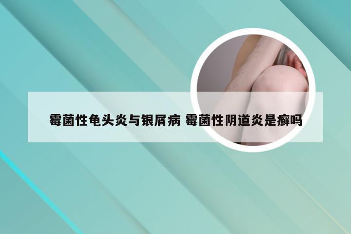 霉菌性龟头炎与银屑病 霉菌性阴道炎是癣吗