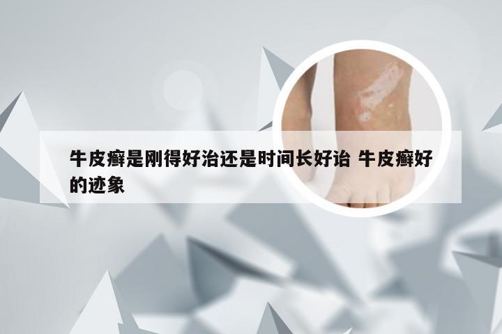 牛皮癣是刚得好治还是时间长好诒 牛皮癣好的迹象