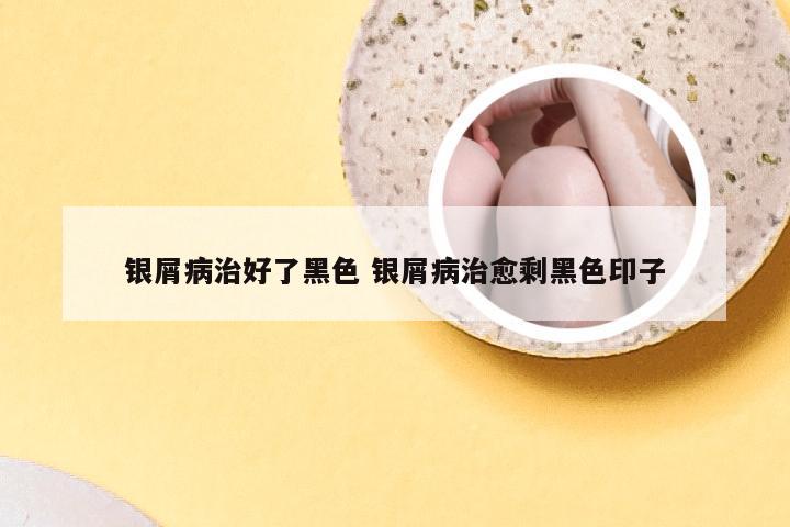 银屑病治好了黑色 银屑病治愈剩黑色印子
