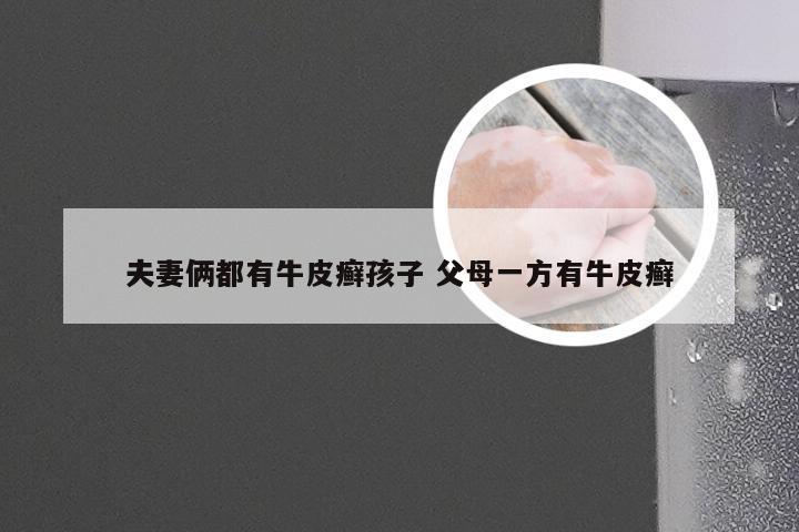 夫妻俩都有牛皮癣孩子 父母一方有牛皮癣