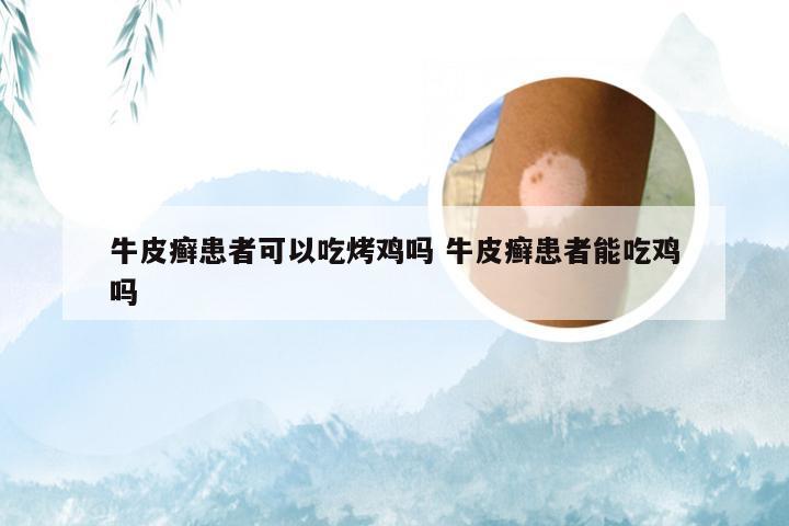 牛皮癣患者可以吃烤鸡吗 牛皮癣患者能吃鸡吗