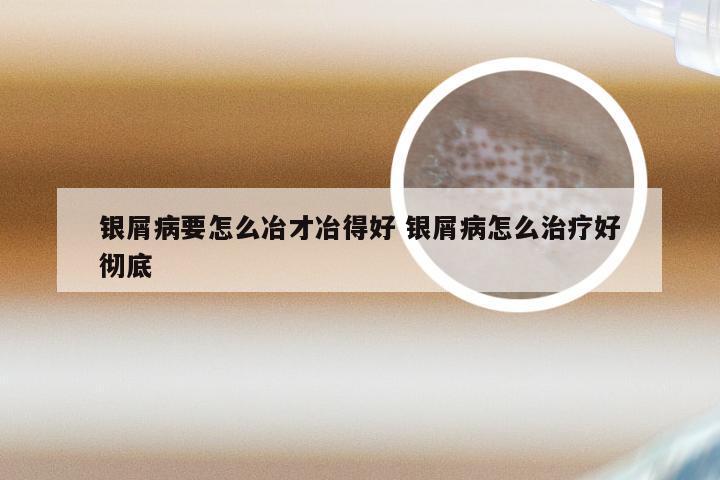 银屑病要怎么冶才冶得好 银屑病怎么治疗好彻底