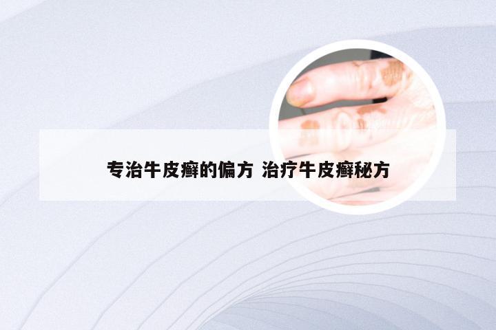 专治牛皮癣的偏方 治疗牛皮癣秘方